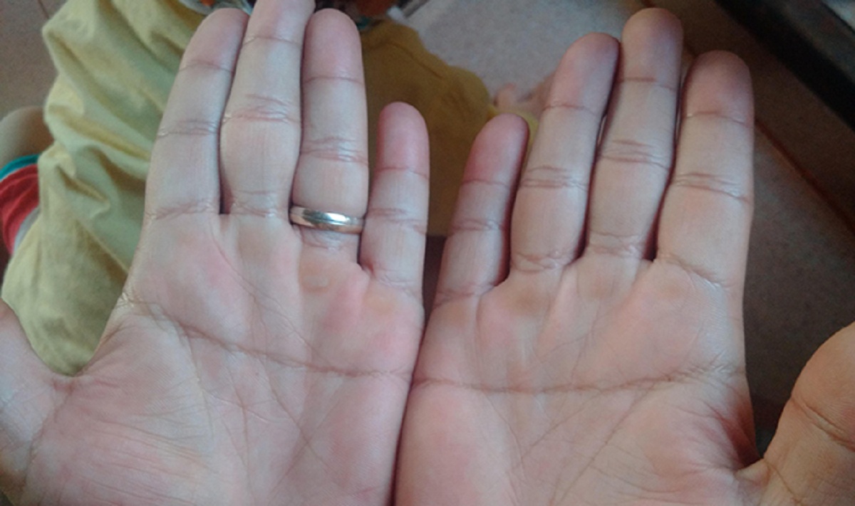Đường cắt dọc ngay giữa lòng bàn tay Marry